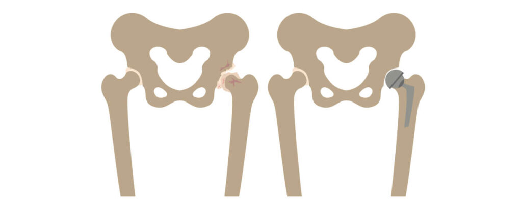 Hip Replacement Rehab: Overcoming Common Challenges