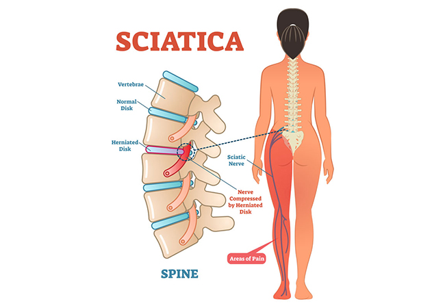 Addressing Sciatic Pain: Start Early for Best Results